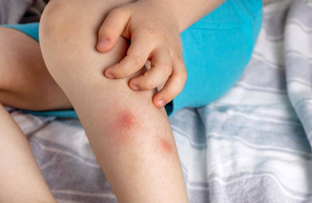 Kid scratching a mosquito bite